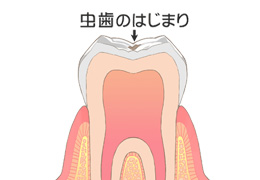 【虫歯初期症状】